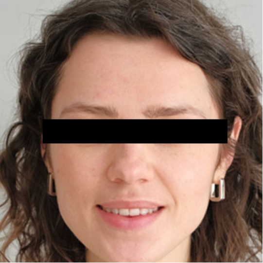 Acne Facial